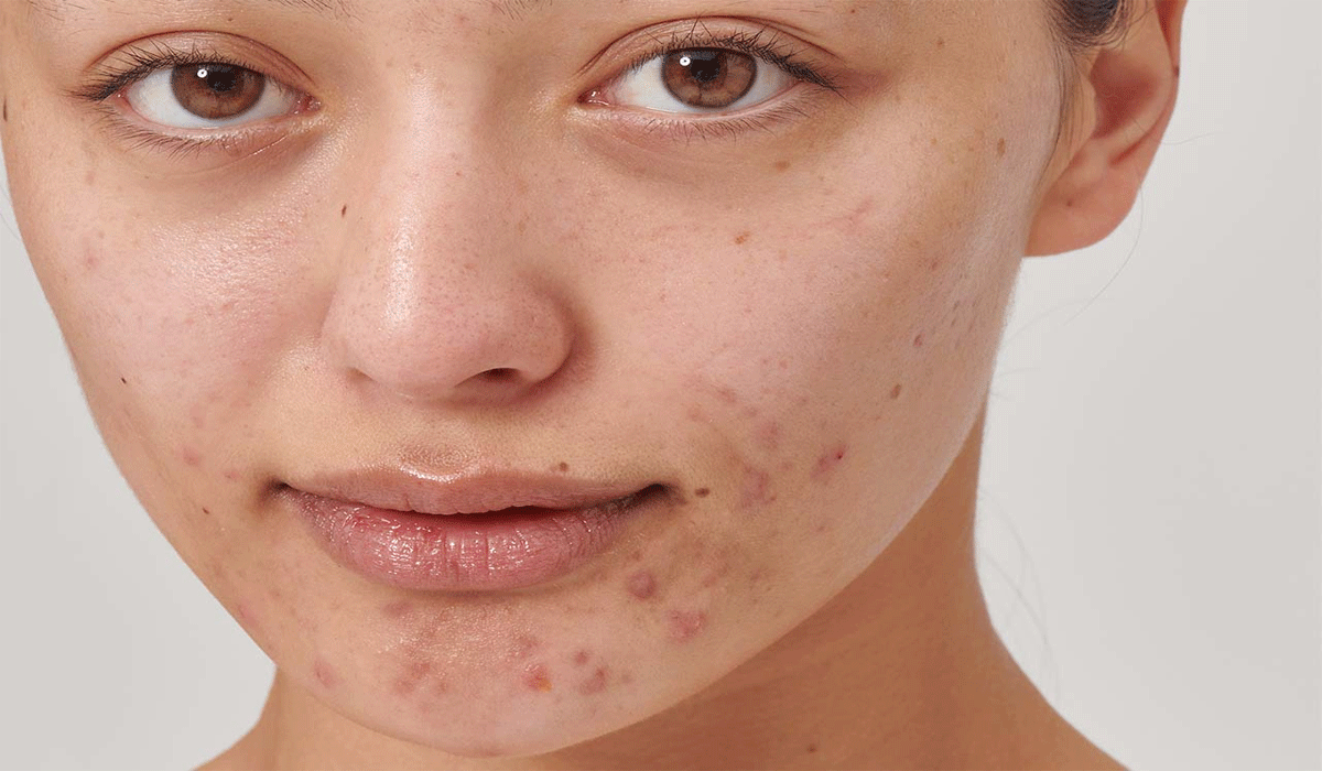 Stress, Aging, and Dull Skin